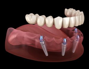 All on Four Dental Implants