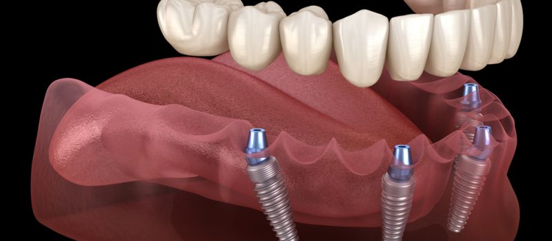 All on Four Dental Implants