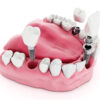 all on four dental implants