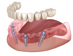 All On 4 Dental Implants