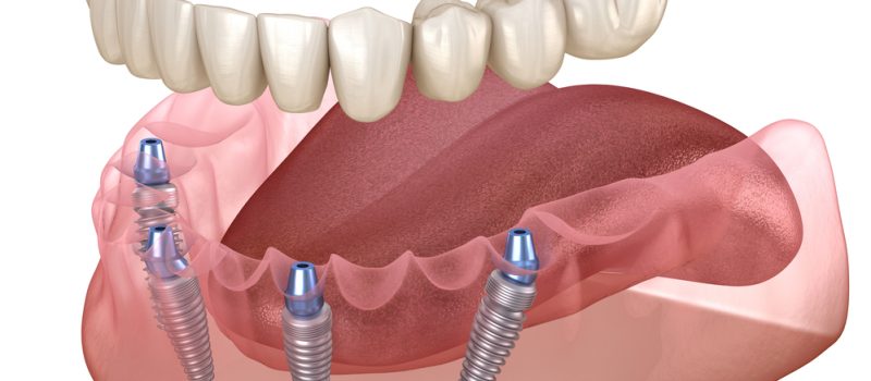 All On 4 Dental Implants