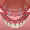 All On 4 Dental Implants
