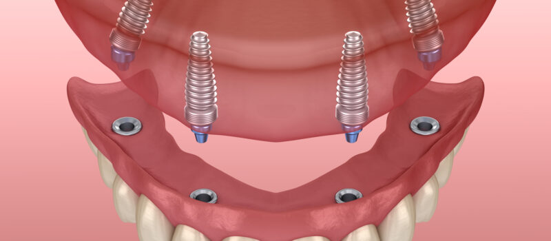 All On 4 Dental Implants